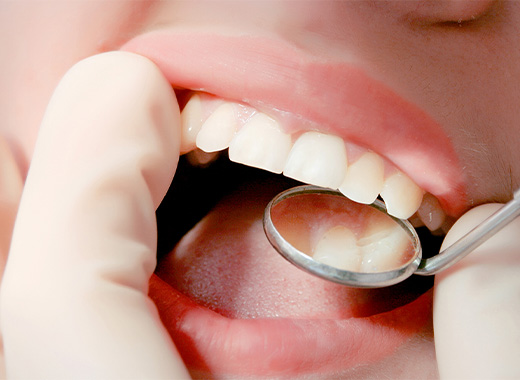 被せ物の除去と現状確認