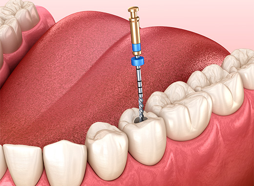 被せ物の除去と現状確認